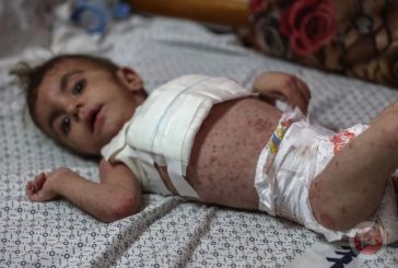 انتشار واسع للأمراض الجلدية في صفوف النازحين بقطاع غزة