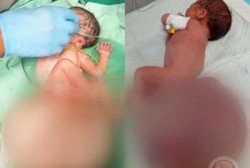 طفلة تولد بورم نادر بغزة